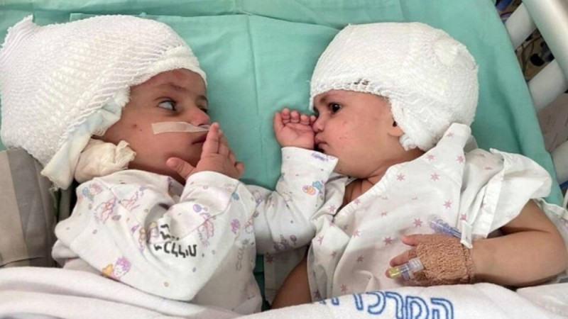 Τα μωρά αυτά το 2020 γεννήθηκαν σιαμαία: Σήμερα κοιτάζονται για πρώτη φορά στα μάτια!