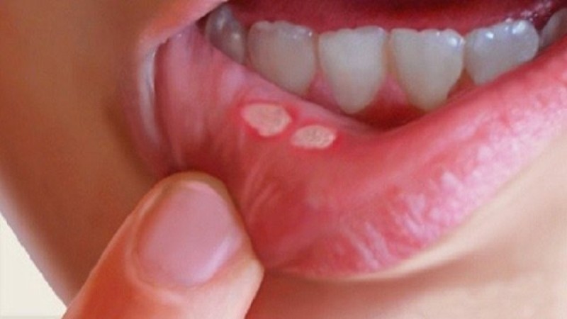 Θεραπεία για τις άφθες στο στόμα