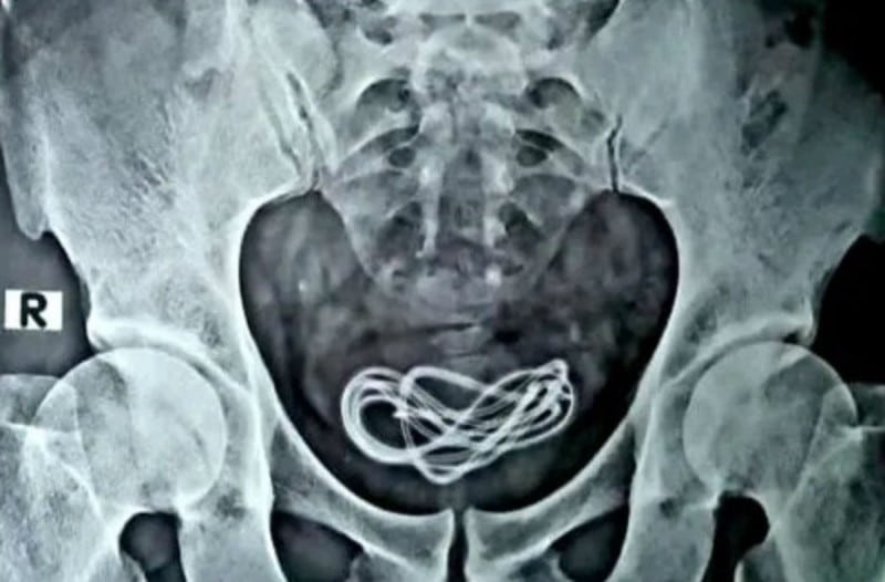 30χρονος πήγε στο νοσοκομείο με αφόρητους πόνους στην κοιλιά - Άφωνος ο γιατρός μόλις είδε την ακτινογραφία (photo)