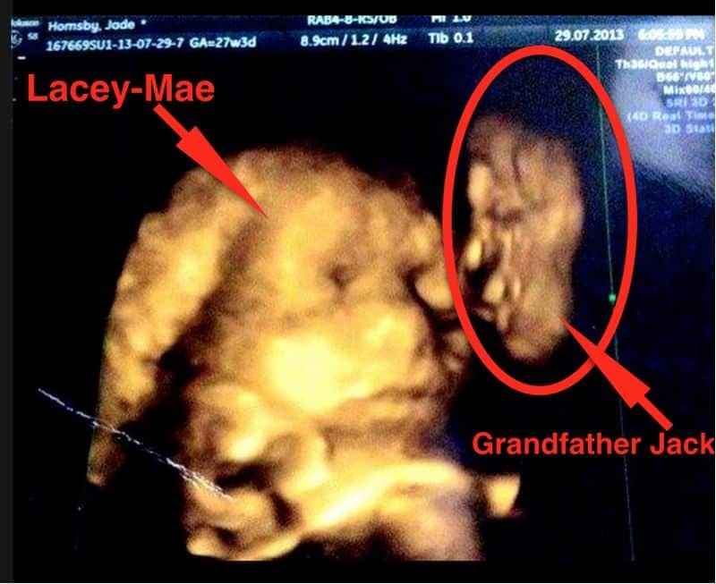 Αυτή η έγκυος όταν πήγε για υπέρηχο περίμενε να δει το μωρό της - Ποιος ήταν όμως αυτός που φαίνεται να φιλάει το μωρό;