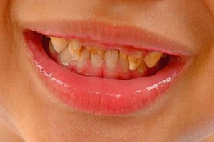 Ποια είναι η νούμερο 1 τροφή που χαλάει τα δόντια των παιδιών;