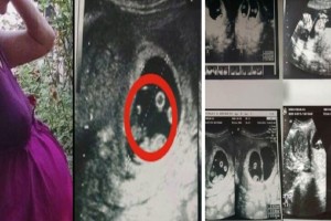 Όταν οι γιατροί είδαν το υπερηχογράφημα της 36χρονης εγκύου φοβήθηκαν ακόμη και να την αγγίξουν - Δεν είχαν αντιμετωπίσει ποτέ κάτι παρόμοιο (photos)
