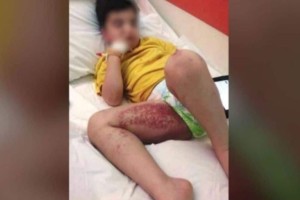 Συναγερμός στο Ναύπλιο: Θαλάσσιες ανεμώνες «επιτέθηκαν» σε παιδιά - Τι πρέπει να κάνετε αν σας τσιμπήσουν;