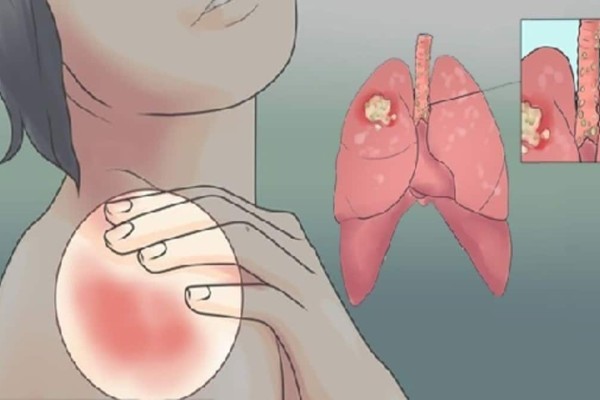 Τα 20 πρώιμα σημάδια του καρκίνου του πνεύμονα που καμία γυναίκα δεν πρέπει να αγνοήσει!