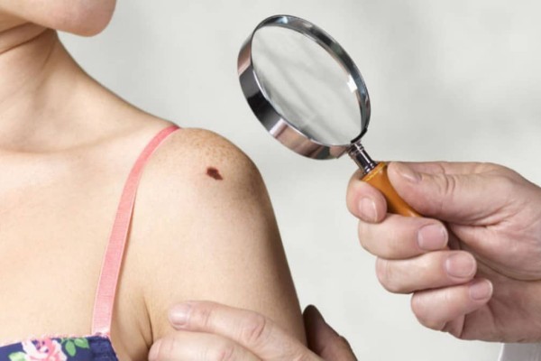 10 αλήθειες για τον καρκίνο του δέρματος, που πιθανότατα δεν γνωρίζετε