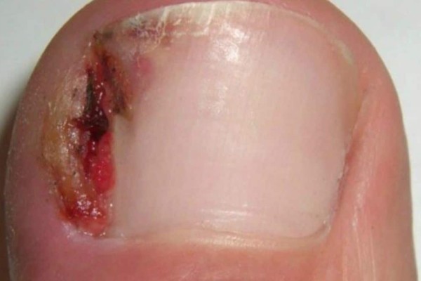 7 θαυματουργές θεραπείες για να απαλλαγείτε από τις παρανυχίδες και τα νύχια που μπαίνουν μέσα στο δέρμα