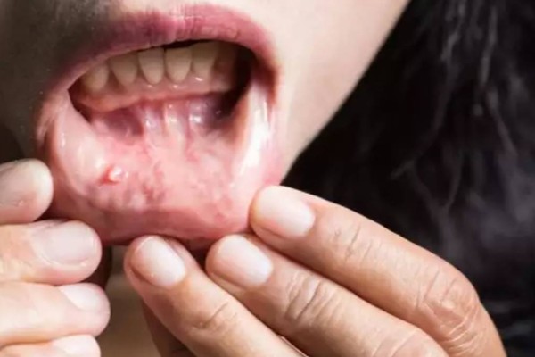 Καρκίνος του στόματος: Αν έχετε αυτά τα σημάδια τρέξτε αμέσως στον γιατρό!