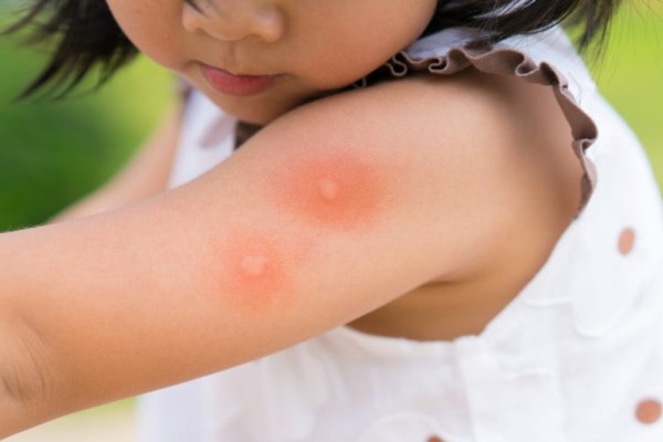 Κουνούπια: Αν νιώσετε αυτά τα συμπτώματα μετά το τσίμπημα τρέξτε αμέσως στο γιατρό