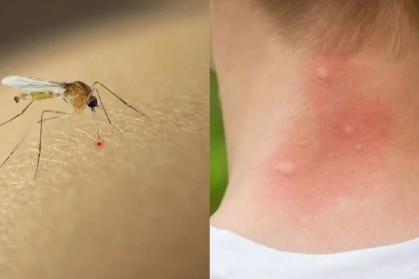 Κουνούπια: Το φυσικό εντομοαπωθητικό που θα σας απαλλάξει για όλο το καλοκαίρι