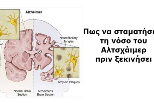 Η πρόληψη σώζει: 9+1 πράγματα που μπορείτε να κάνετε για να προλάβετε τη νόσο του Αλτσχάιμερ!