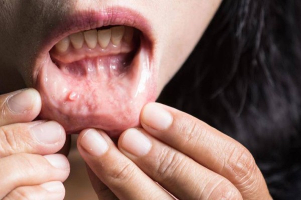 Καρκίνος: Αν νιώθετε αυτό τον πόνο στα δόντια τρέξτε αμέσως στο γιατρό