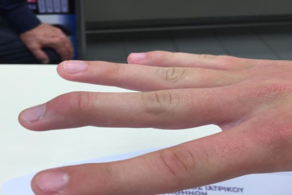 Καρκίνος: Τι δείχνουν τα δάχτυλα; 8+1 περίεργες “συνδέσεις” του σώματος