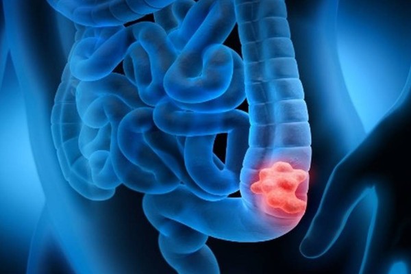 Καρκίνος Παχέος Εντέρου: Το πασίγνωστο χάπι που μειώνει κατά 50% τον κίνδυνο