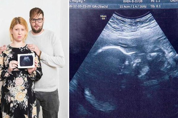 Έγκυος μητέρα ενημερώθηκε ότι το μωρό που κυοφορεί θα πεθάνει αλλά συνεχίζει την εγκυμοσύνη της για να δωρίσει τα όργανά του