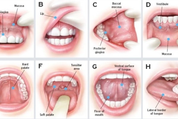 Καρκίνος: Το πρόβλημα στο στόμα που αυξάνει τον κίνδυνο 90%!
