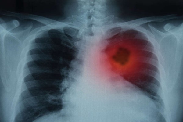 Καρκίνος του πνεύμονα: Τα σημάδια που πρέπει να δώσετε προσοχή - Τι μπορείτε να κάνετε προληπτικά