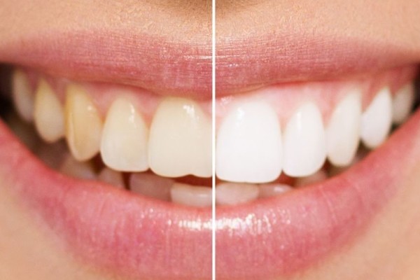 Έτσι θα αποκτήσετε κατάλευκα δόντια χωρίς να πάτε στον οδοντίατρο