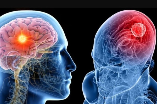 Καρκίνος στο κεφάλι: Προσοχή στα ύπουλα συμπτώματα!