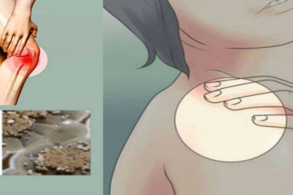 Δηλητηρίαση της μούχλας: Τι είναι και πώς θα προφυλαχτείτε