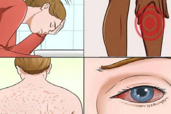 Δεν έχετε ιδέα: 17 συμπτώματα της ασθένειας της μούχλας και πώς να την καταπολεμήσετε