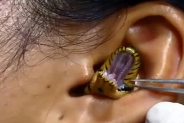 Σκέτη ανατριχίλα: «Χειρουργός» παλεύει να αφαιρέσει ζωντανό φίδι από το αυτί γυναίκας (Video)