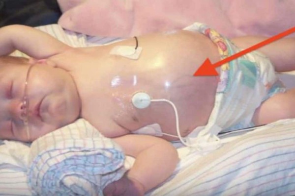 Γιατροί παρατήρησαν την κοιλιά ενός μωρού και τρόμαξαν... Όταν όμως εξέτασαν την δίδυμη αδερφή της έπαθαν σοκ!