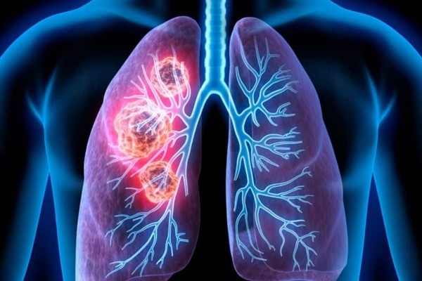 Εθνική στρατηγική για την πρόληψη του καρκίνου του πνεύμονα