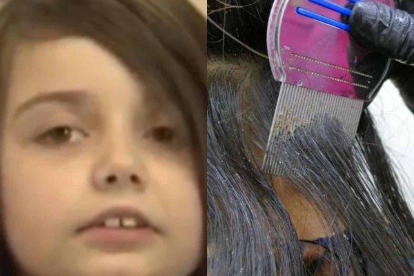Θλίψη: Νεκρή 12χρονη από ψείρες που της ήπιαν όλο το αίμα - Συνελήφθησαν οι γονείς (photos-video)
