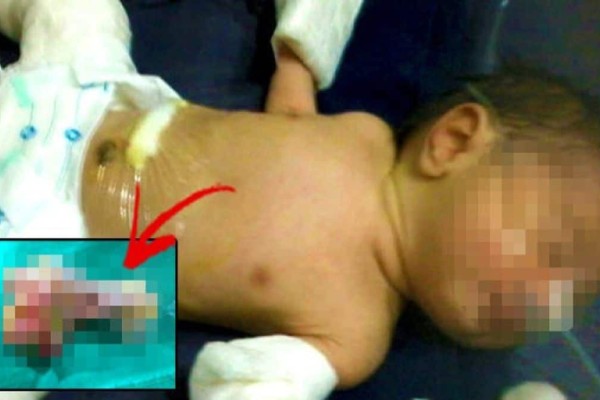 Το στομάχι του μωρού φούσκωνε και οι γιατροί αποφάσισαν να το ανοίξουν - Δεν πίστευαν τι είχε μέσα (photo)