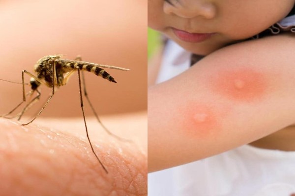 «Πλάκωσαν» τα κουνούπια: Τα συμπτώματα μετά το τσίμπημα που δεν πρέπει να αγνοήσετε