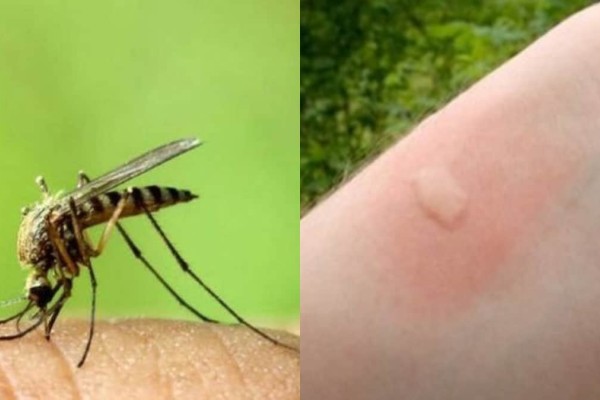 Τσίμπημα κουνουπιού: 3 σπιτικά κόλπα για να αντιμετωπίσετε την φαγούρα δραστικά