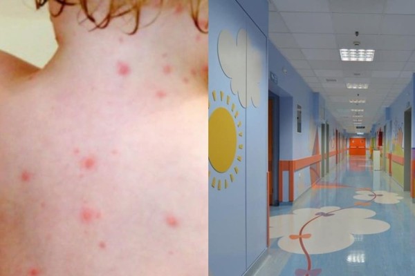Σε έξαρση η ιλαρά στην Ελλάδα: Έντονη ανησυχία των ειδικών - Η περιοχή που είναι στο «κόκκινο»