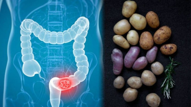 Καρκίνος του παχέος εντέρου: Πώς συνδέεται με τις πατάτες που τρώτε