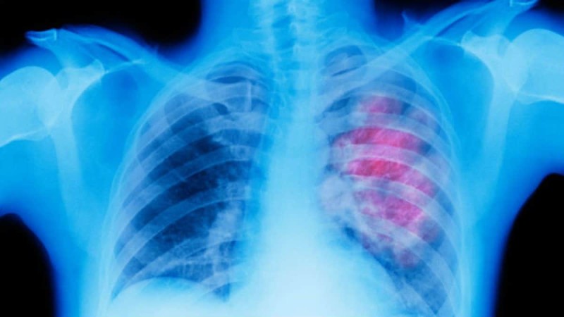 Το εμβόλιο κατά του καρκίνου του πνεύμονα είναι πλέον γεγονός
