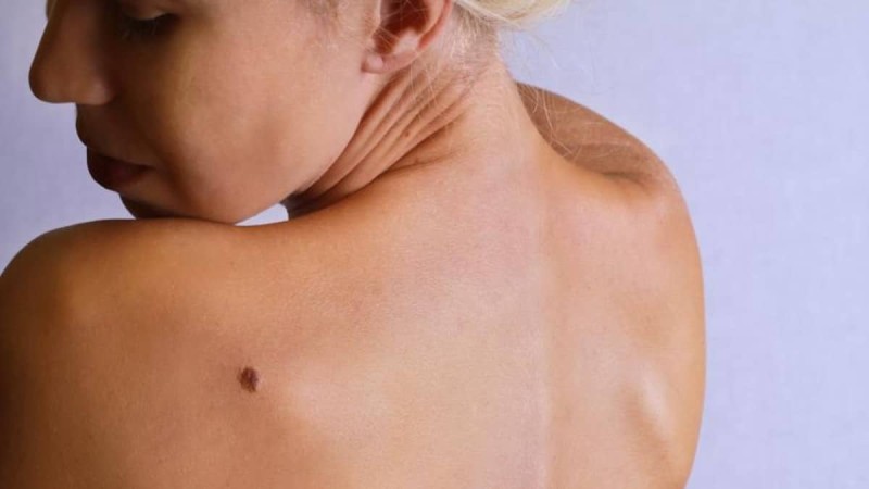 Νόσος Μπόουεν: Καρκίνος του δέρματος