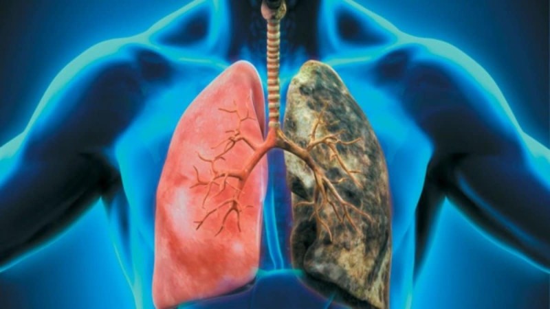 Εμβόλιο για τον καρκίνο του πνεύμονα