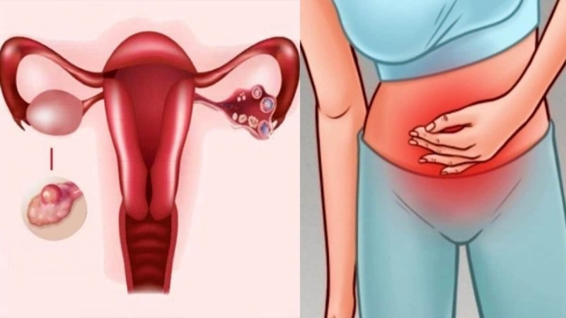 10 συμπτώματα του καρκίνου των ωοθηκών που κάθε γυναίκα πρέπει να γνωρίζει