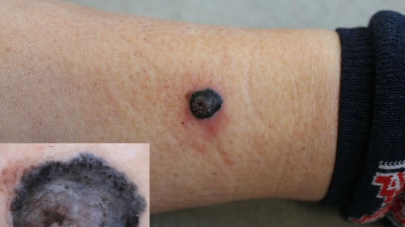 Μελάνωμα: Λιγότερο από το 30% των περιπτώσεων συνδέεται με προϋπάρχουσες ελιές στο δέρμα