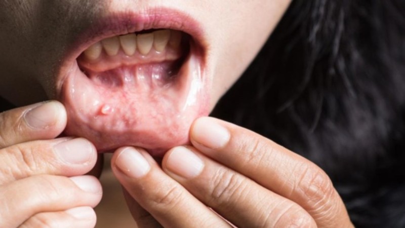 Καρκίνος στόματος: 8 ανησυχητικά συμπτώματα - Ποιοι παράγοντες τον προκαλούν