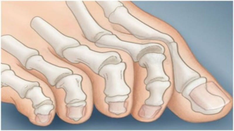 Τα νύχια των ποδιών σας δείχνουν αν κινδυνεύετε από καρκίνο