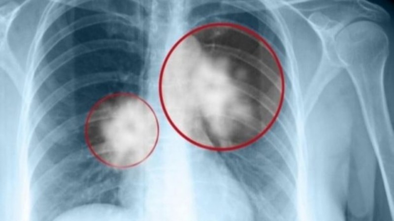 Καρκίνος του πνεύμονα: Ποια είναι τα πρώτα σημάδια και τα στάδια