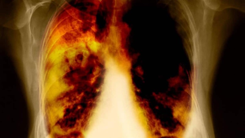 Σώζει ζωές: Τα 7 σημάδια που προειδοποιούν για καρκίνο των πνευμόνων