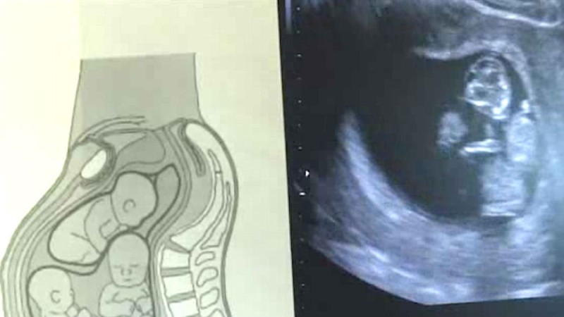 Ήταν έγκυος σε τρίδυμα αλλά όταν οι γιατροί είδαν αυτό τον υπέρηχο 'έμειναν'!