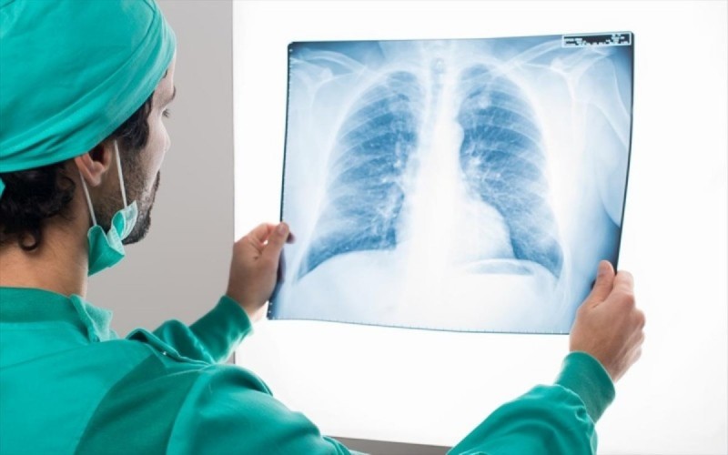 Καρκίνος του πνεύμονα συμπτώματα