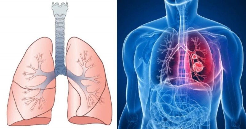 11 σημάδια του καρκίνου του πνεύμονα που πρέπει να γνωρίζετε
