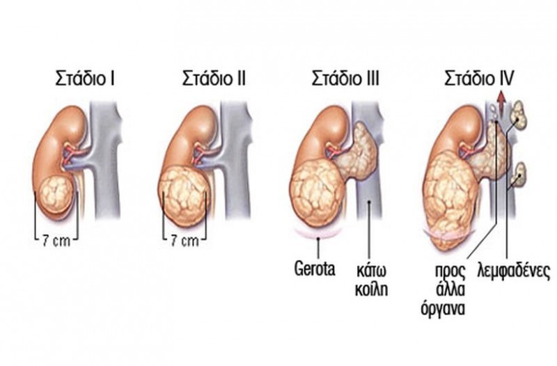 Καρκίνος στα νεφρά – συμπτώματα