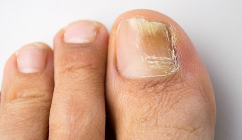 Αν παρατηρήσετε αυτό το σημάδι στα νύχια των ποδιών σας τότε πρέπει να επισκεφθείτε αμέσως το γιατρό σας