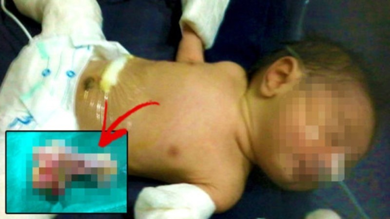 Το στομάχι του μωρού φούσκωνε και οι γιατροί αποφάσισαν να το ανοίξουν... Μόλις είδαν τι είχε μέσα έπαθαν σοκ! (photos)