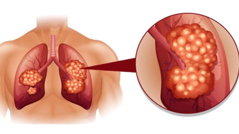 Καρκίνος στον πνεύμονα: 8 σημάδια που πρέπει να σας προβληματίσουν - Τρέξτε στον γιατρό σας