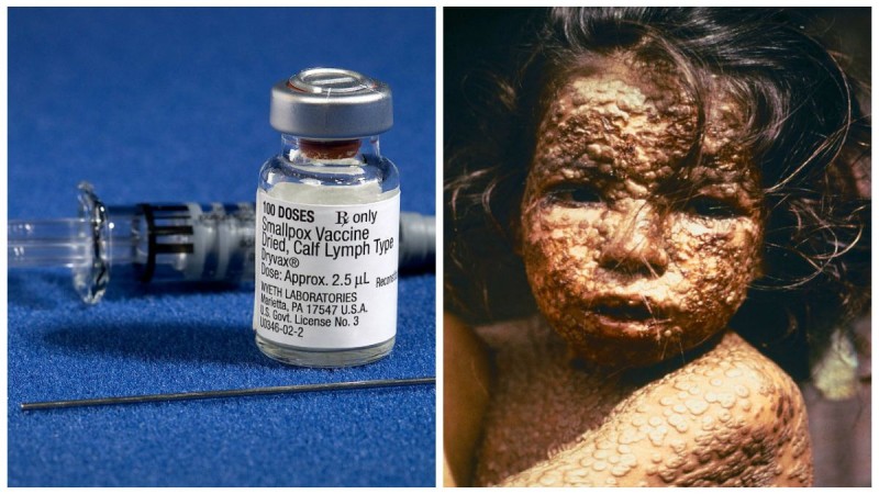 Ευλογιά: Η ασθένεια που εξαφάνισαν τα εμβόλια – Το παράδειγμα για τους αντιεμβολιαστές